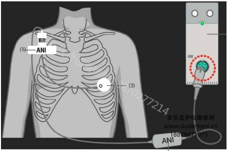 迈瑞N22监护仪ANI测试